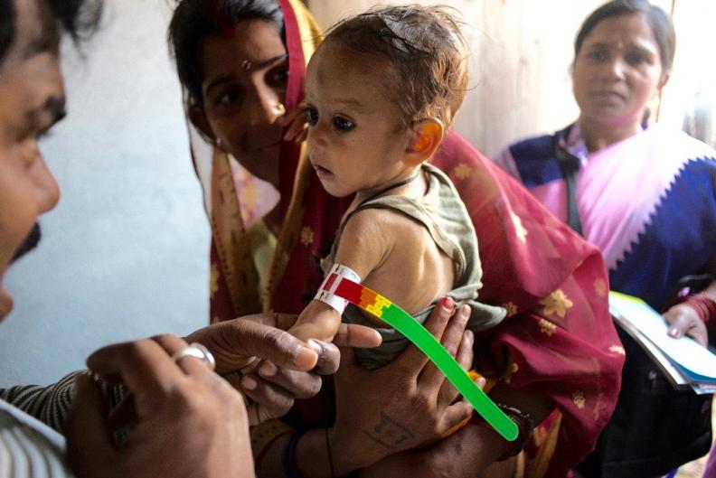 Mehrotra S, Child Malnutrition and Gender Discrimination in South Asia, 2006: Economic and Political Weekly, Vol: 41, No: 10, p912-918.